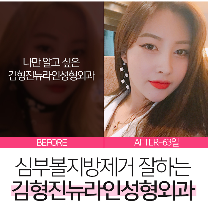 심부볼지방제거성형외과 김형진뉴라인, 알죠? 관련 이미지 8