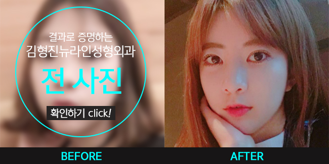 부분절개로 쌍꺼풀 내것인듯 자연스럽게! 관련 이미지 3