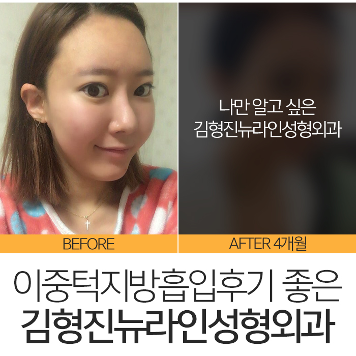 이중턱지방흡입후기 솔직하게 관련 이미지 3