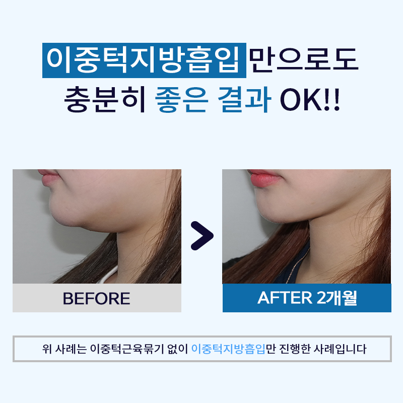 이중턱지방흡입처짐 걱정없어요! 관련 이미지 4