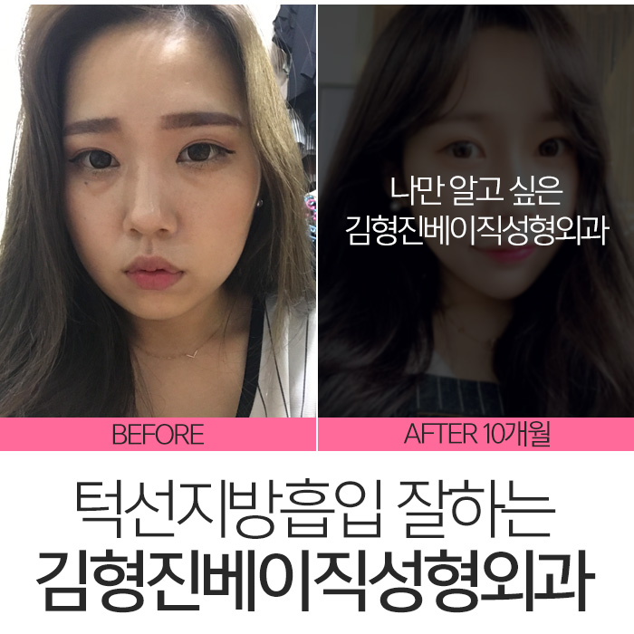 턱선지방흡입 김형진베이직성형외과 짜란다 관련 이미지 7