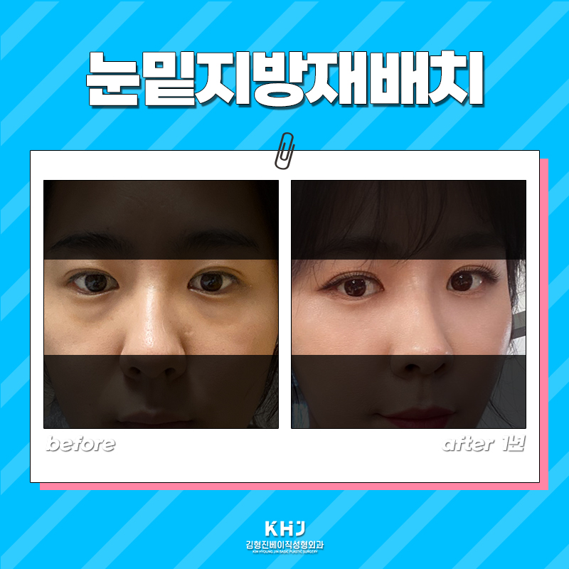 신사눈밑지 애교살 밑으로 접히는 눈 밑 지방 해결했어요 관련 이미지 6