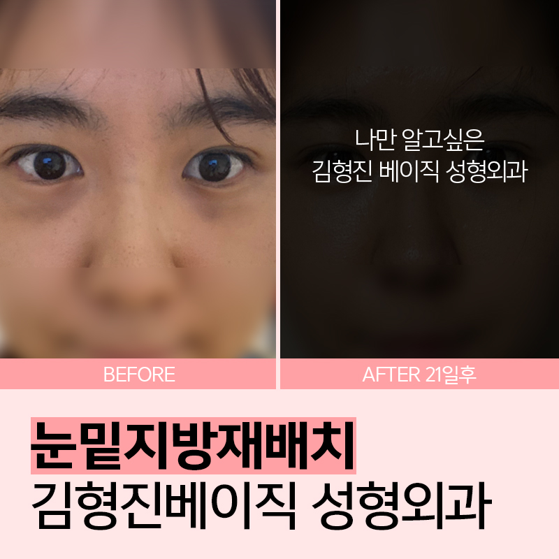 피곤해보일땐 눈밑지방재배치수술이 딱! 관련 이미지 5