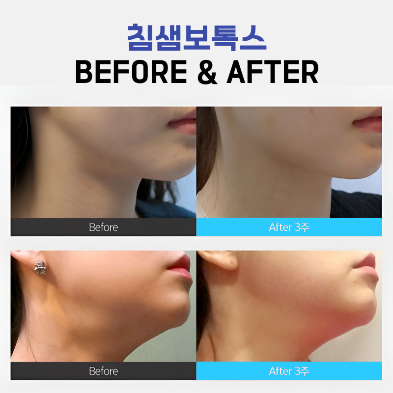 침샘보톡스주기 제대로 알려주는 유일했던 곳 관련 이미지 6