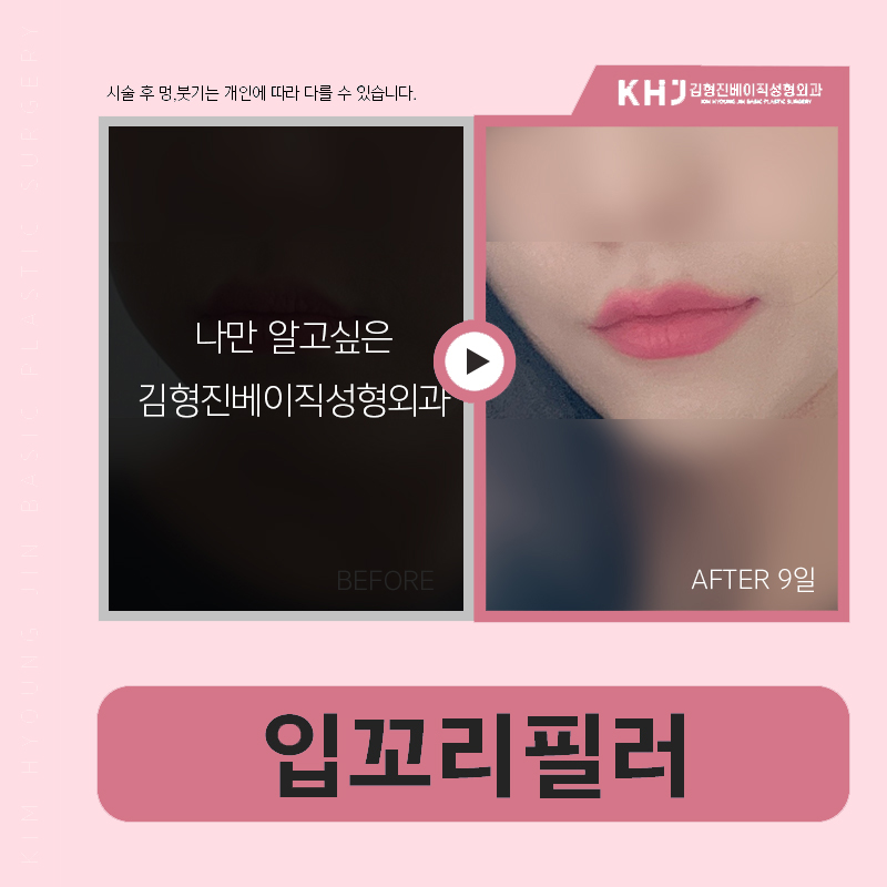 Want to see a clear lip-corner filler effect? image 6