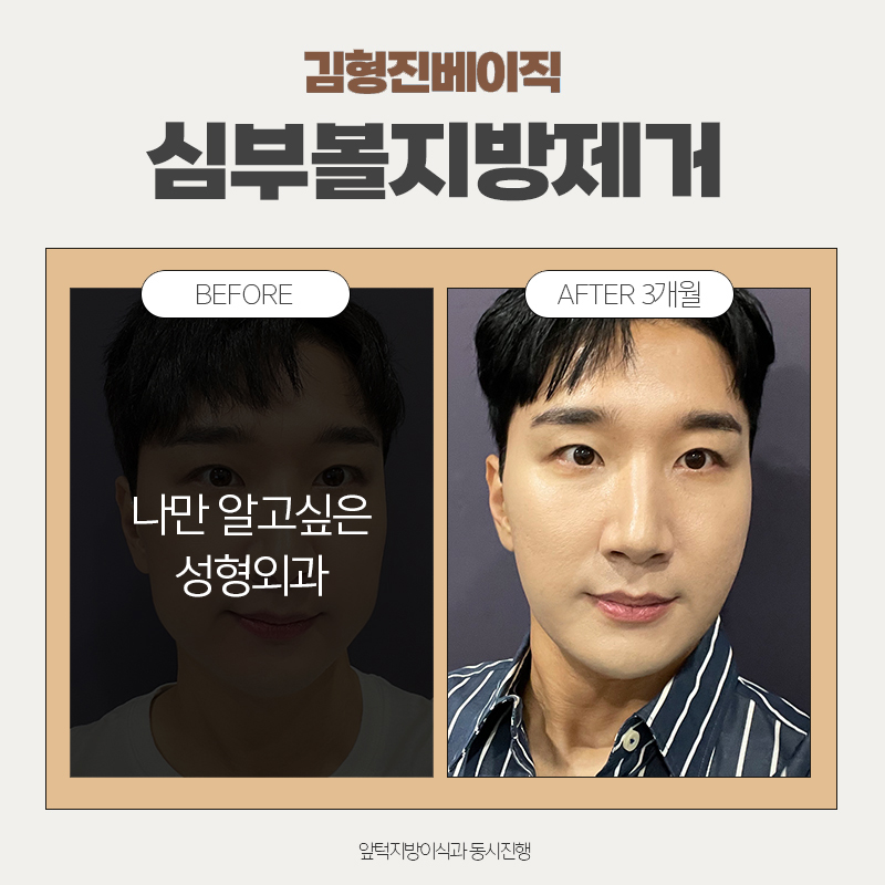 심부볼리프팅의 핵심, 이것 밖엔 방법이 없습니다! 관련 이미지 8