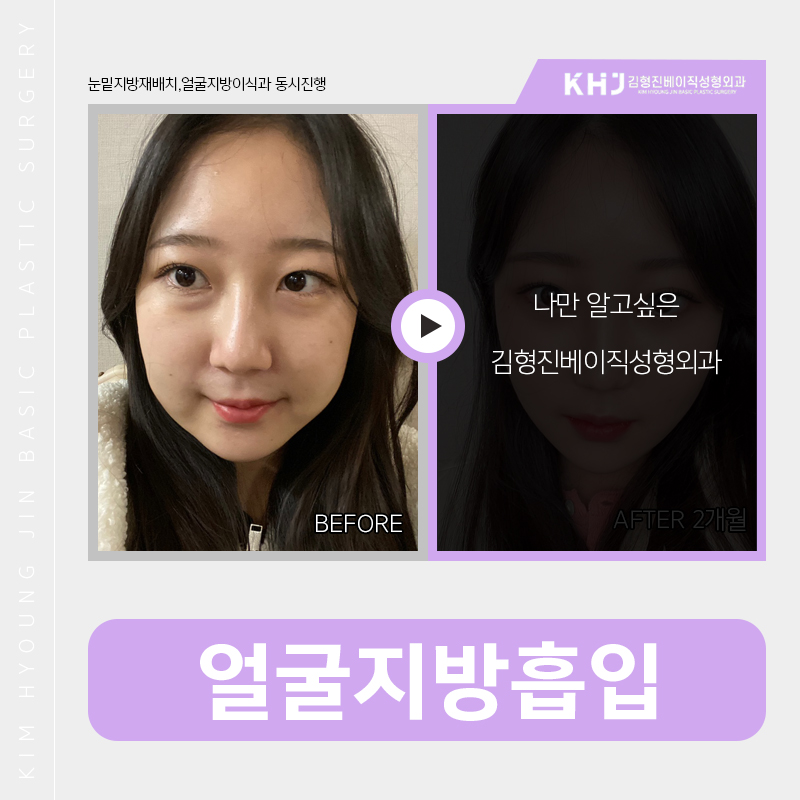 얼굴지방흡입붓기 걱정이시라구요? 관련 이미지 2