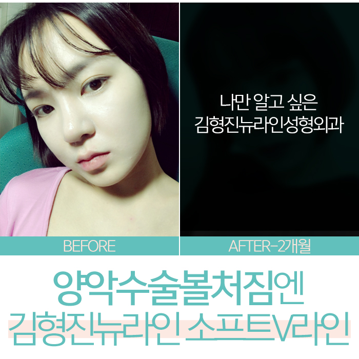 안면윤곽후리프팅 정답이라고 확신해요? 관련 이미지 7