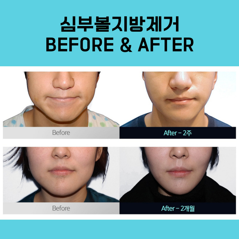 Cheek Fat Removal at a Place That Specializes in It image 4