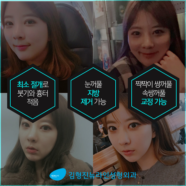 부분절개로 쌍꺼풀 내것인듯 자연스럽게! 관련 이미지 2