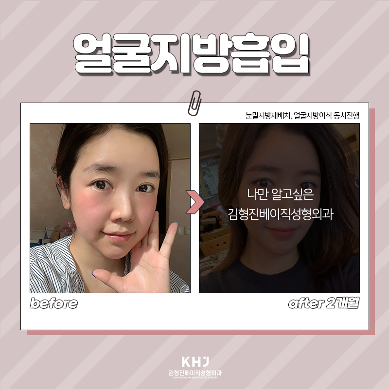 얼굴지방흡입방법 궁금하셨다면 관련 이미지 5