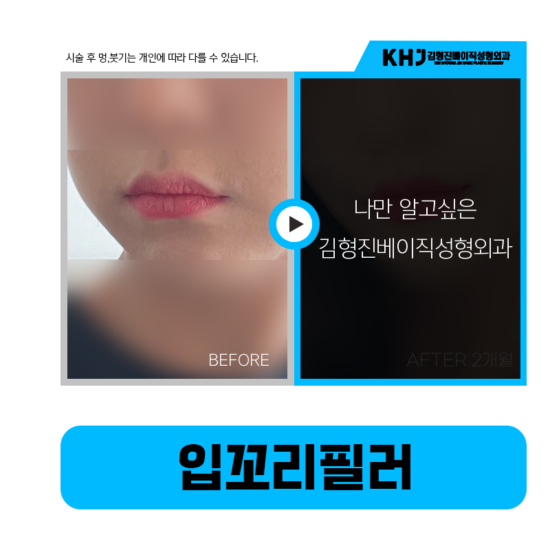 나이 들어 보이는 이유는 처진입꼬리 탓! 쉽게 해결하는 방법은? 관련 이미지 5