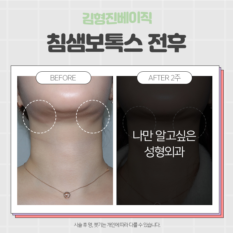 침샘보톡스효과가 궁금하셨다면? 관련 이미지 5