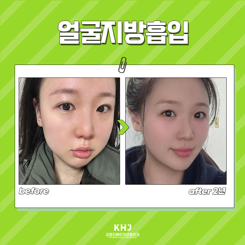 Here’s a Facial Liposuction Review~ image 6