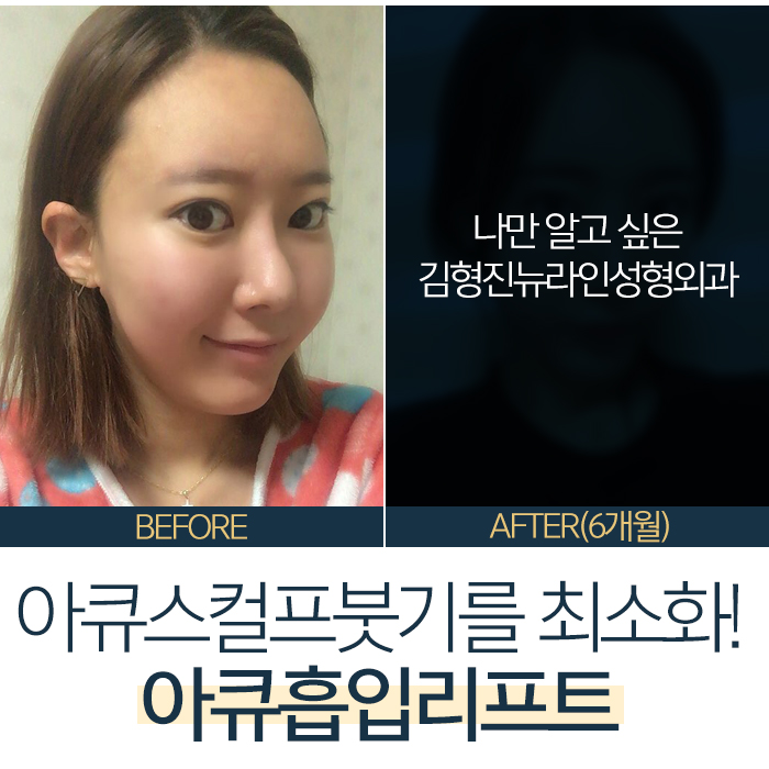 아큐스컬프붓기 급이 다른 이유 관련 이미지 2