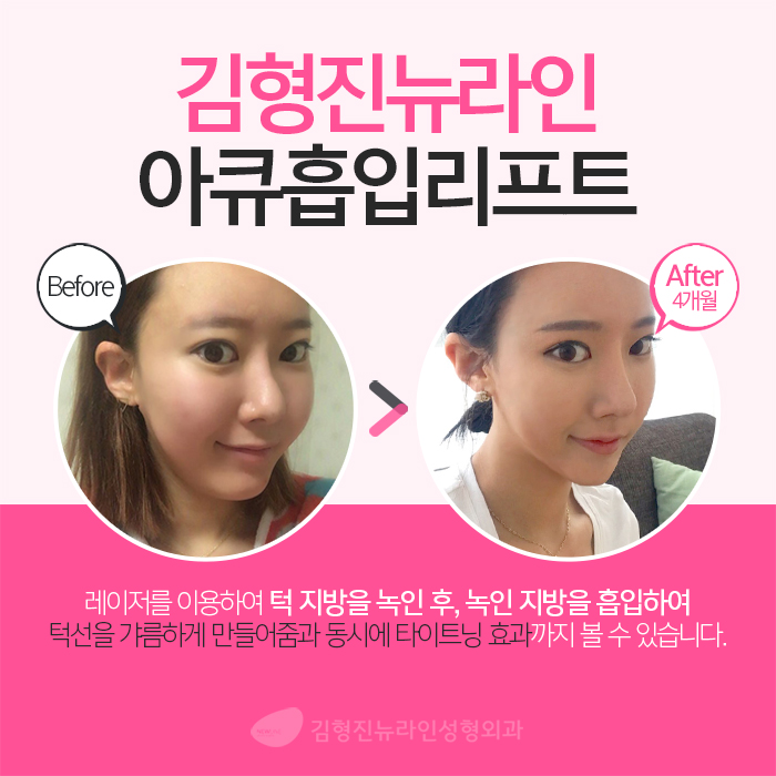 턱라인지방흡입 김형진원장이 체고야! 관련 이미지 5