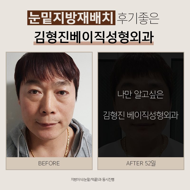 눈밑지방재배치후기 봐주실 분 관련 이미지 6