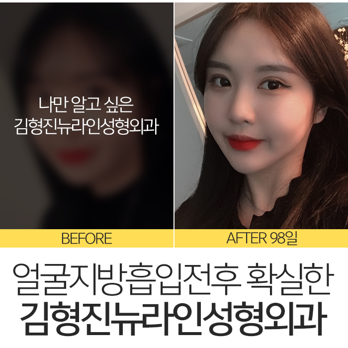 얼굴지방흡입전후 제대로 보려면 관련 이미지 2