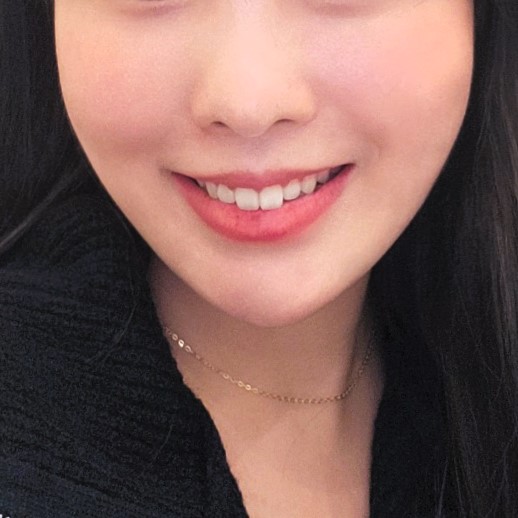 역대급 강남입꼬리필러후기 보고 갈 사람? 관련 이미지 3