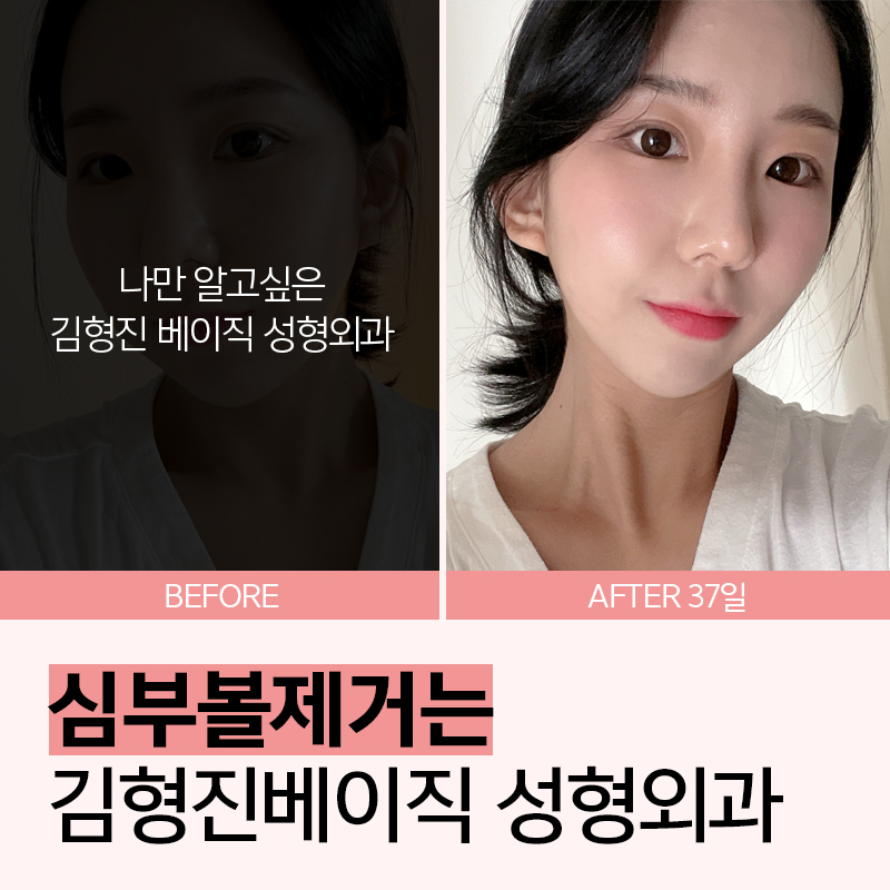 심부볼지방제거수술로 처진 불독살 개선 끝 관련 이미지 4