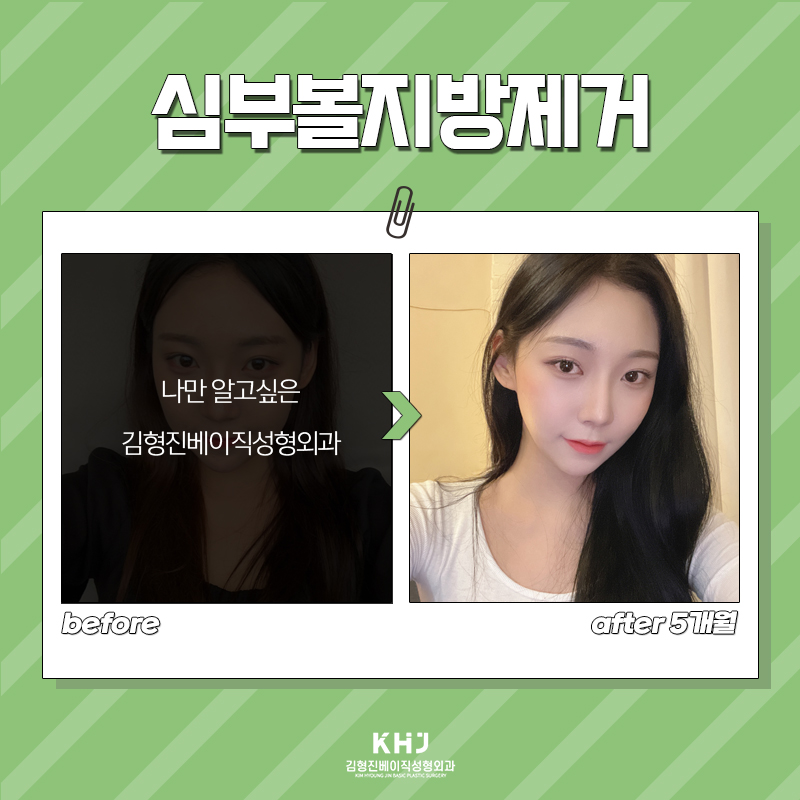 당신만 모르는 심부볼없애는법, 이 방법이 가장 빠릅니다! 관련 이미지 6