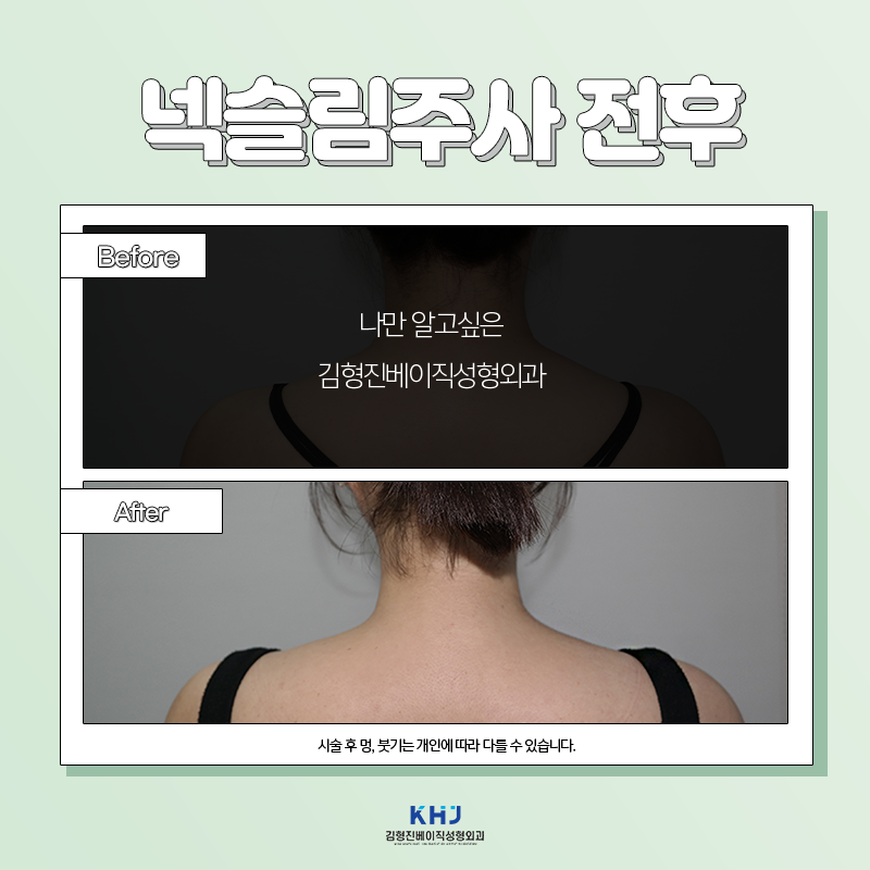 넥슬림주사전후 이렇게나 대단해! 관련 이미지 4