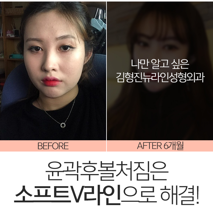 윤곽후볼처짐 해결하려면 관련 이미지 2