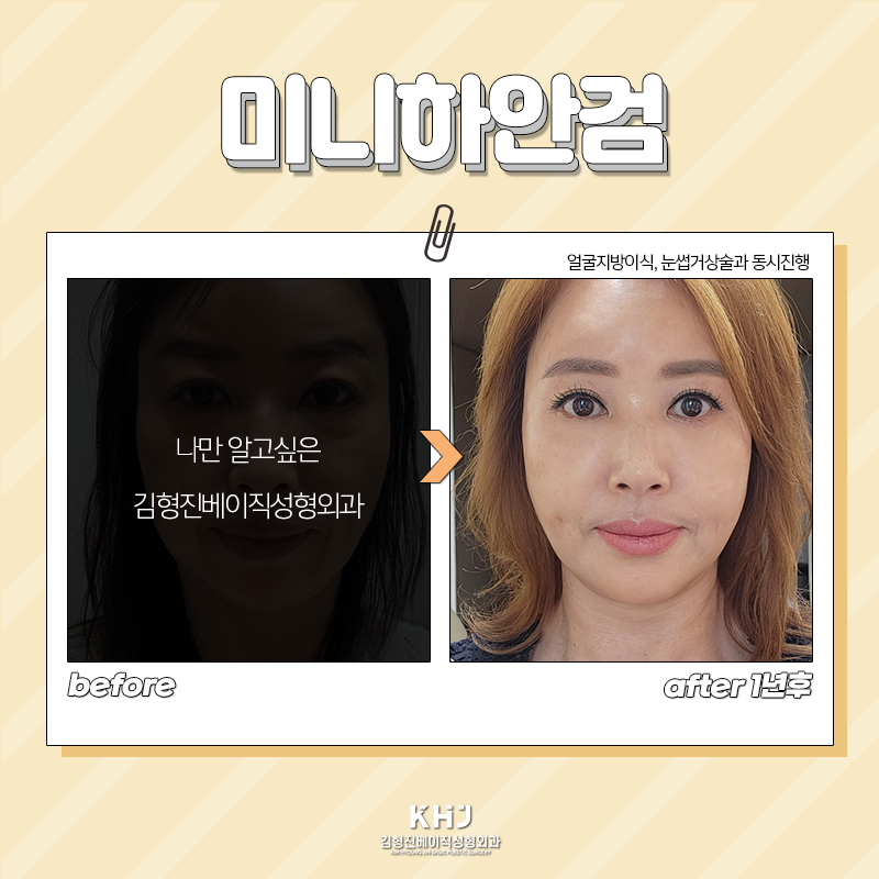 미니하안검흉터 걱정되시죠? 관련 이미지 4