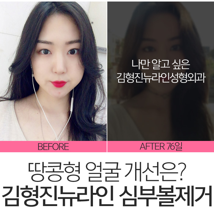 땅콩형얼굴 고민만 하고 있나요? 관련 이미지 8