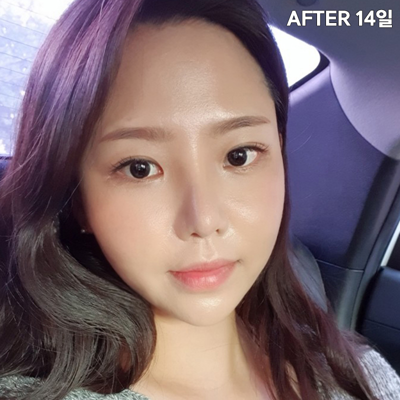 얼굴살빼는법! 전후 차이 확실하게 관련 이미지 4