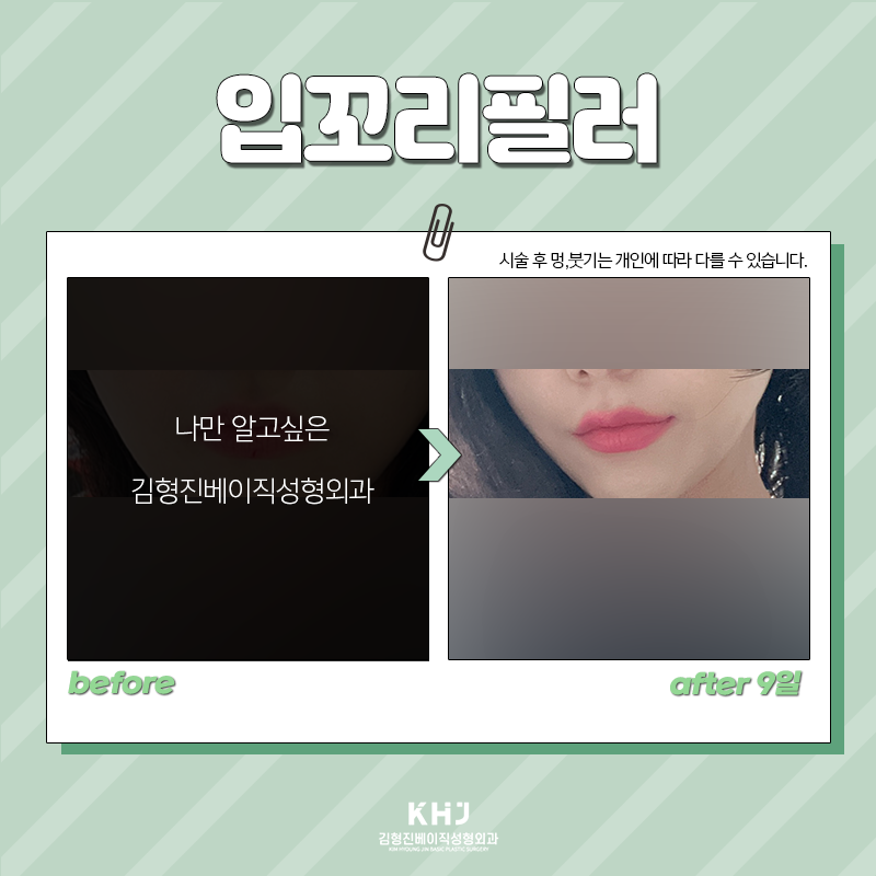입꼬리필러모양 자연스럽게 원하신다면 관련 이미지 6
