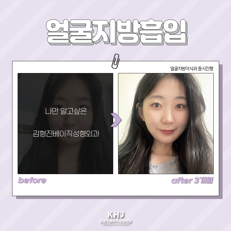 얼굴지방흡입전후 확인하고 가세요! 관련 이미지 6