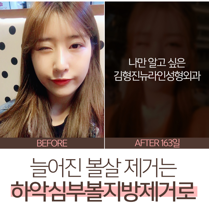 늘어진볼살 제거하는법이 궁금해? 관련 이미지 3