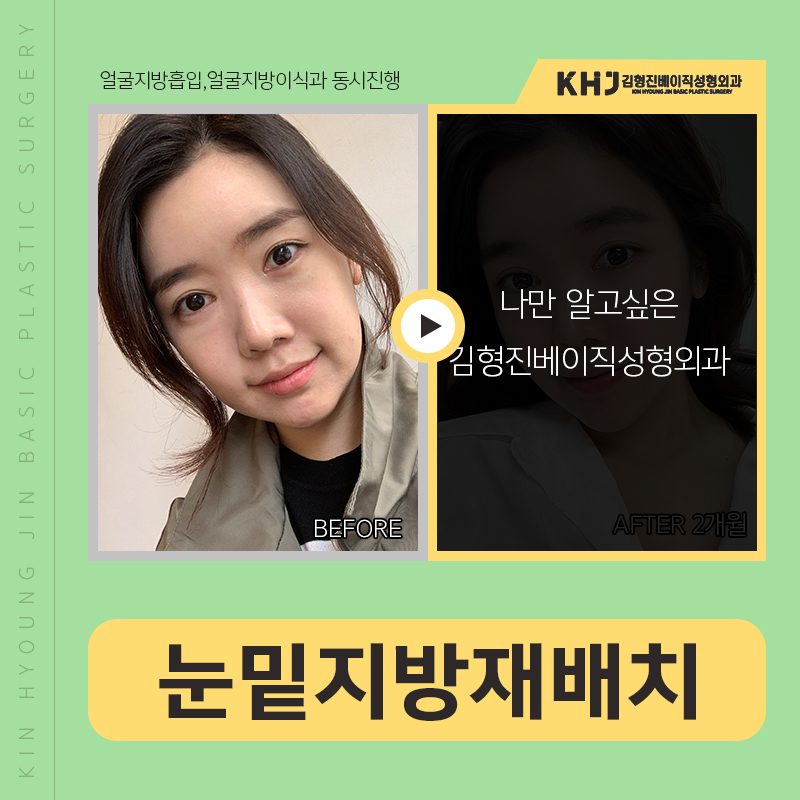 눈밑지방재배치붓기 걱정되신다구요? 관련 이미지 5