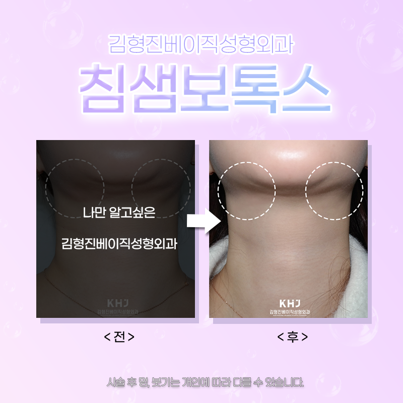 침샘비대증보톡스 효과 볼 수 있는 곳으로 가셔야죠! 관련 이미지 6