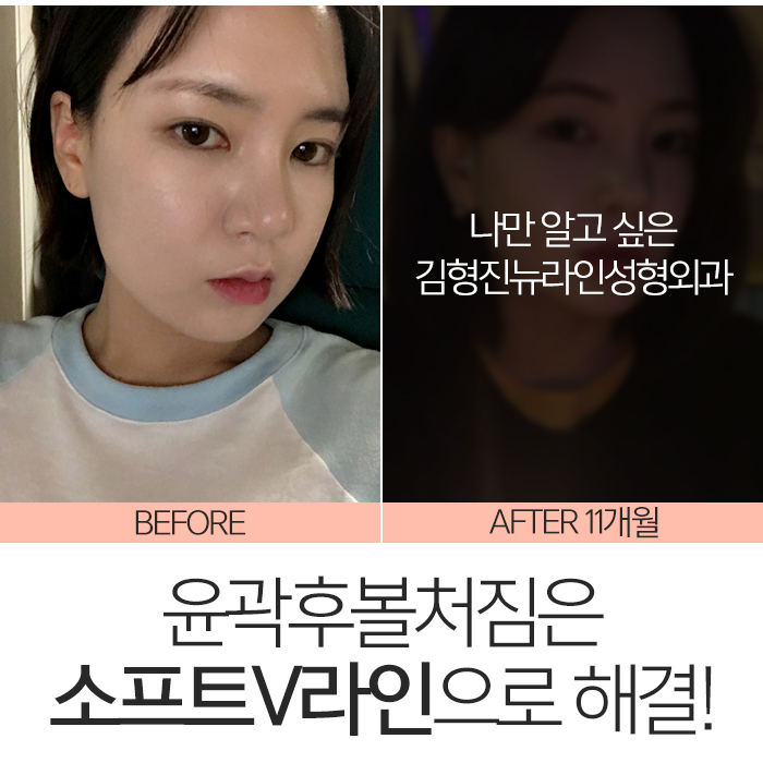 윤곽후볼처짐 해결하려면 관련 이미지 7