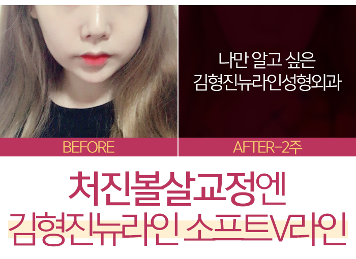 처진볼살교정 하고싶다면 관련 이미지 2