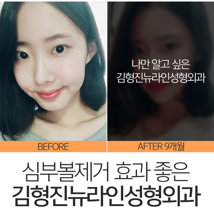 심부볼효과 확실하니까 관련 이미지 8