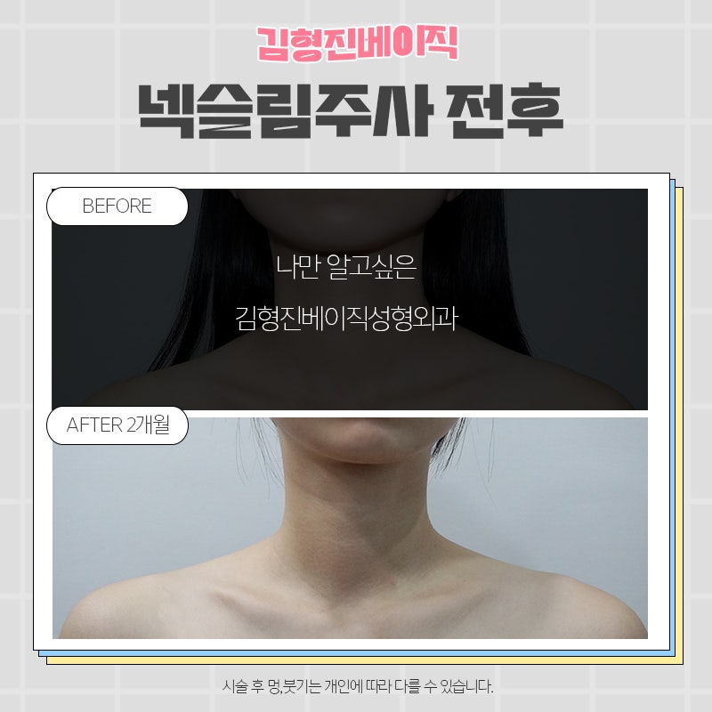 넥슬림보톡스전후 궁금하신분!? 관련 이미지 8