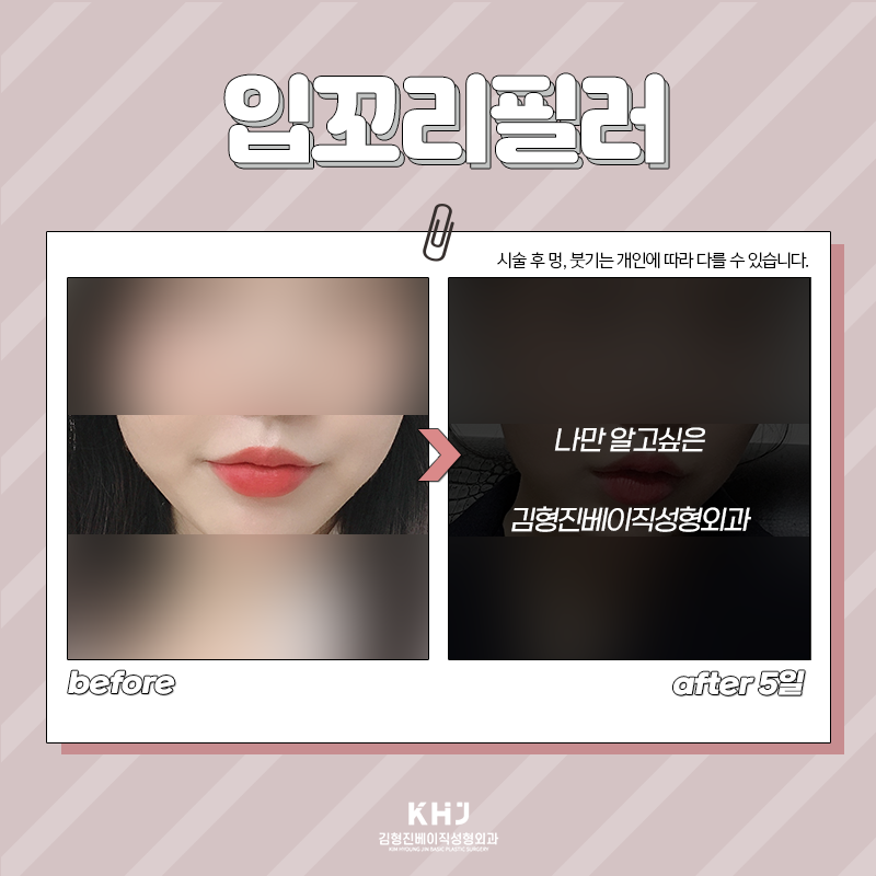 입꼬리비대칭 개선하는 방법 찾으셨다면 관련 이미지 5