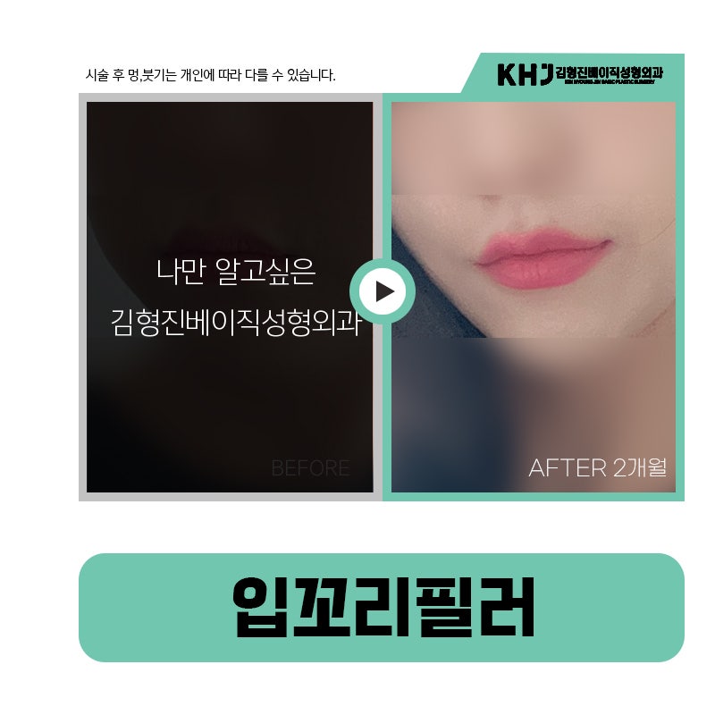 입꼬리필러전후 보고 여기로 마음 굳혔어요! 관련 이미지 6