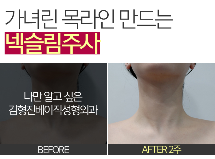 넥라인보톡스 진짜 해야 할때 (a.k.a 김형진베이직 넥슬림주사) 관련 이미지 2
