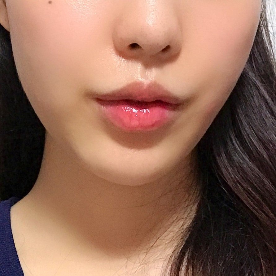 축 처진 입매 교정하는 입꼬리필러시술이 궁금하다면 관련 이미지 2