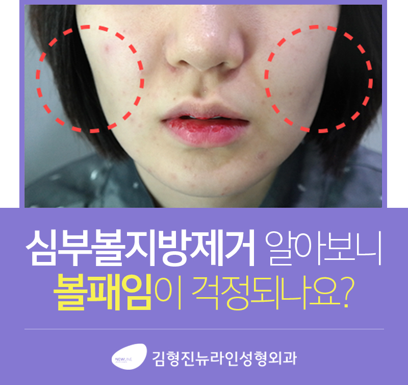 심부볼패임 무조건 온다고? 관련 이미지 2