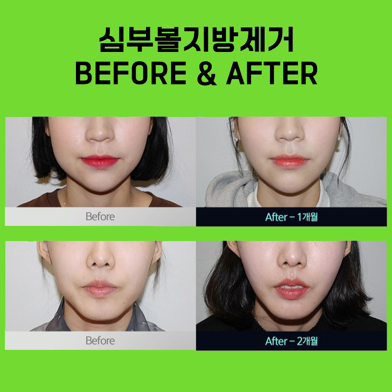 관리하는 사람들은 다 알고 있는 심부볼없애는방법 관련 이미지 6