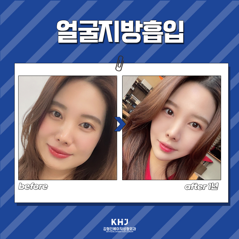 얼굴지흡수술 계속 고민 중이시면 관련 이미지 6