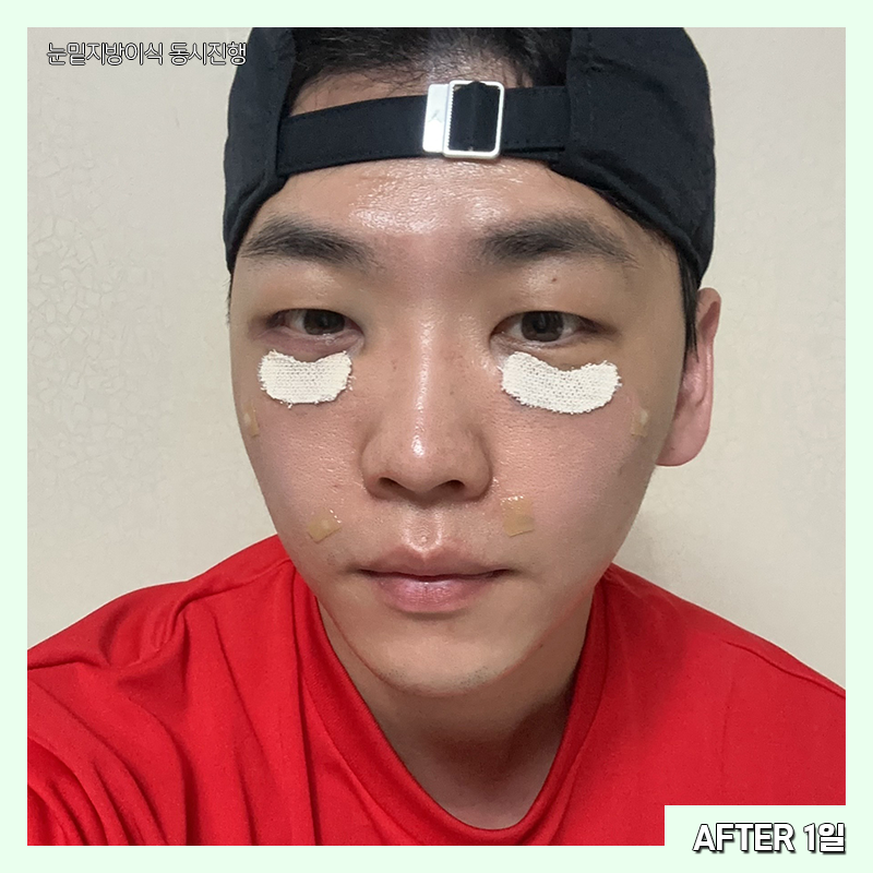 눈밑지방재배치흉터 걱정하지 마세요! 관련 이미지 4