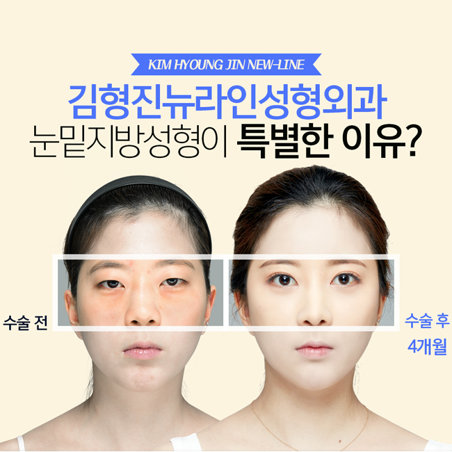 효도성형은 눈밑지방재배치로 초이스~ 관련 이미지 1