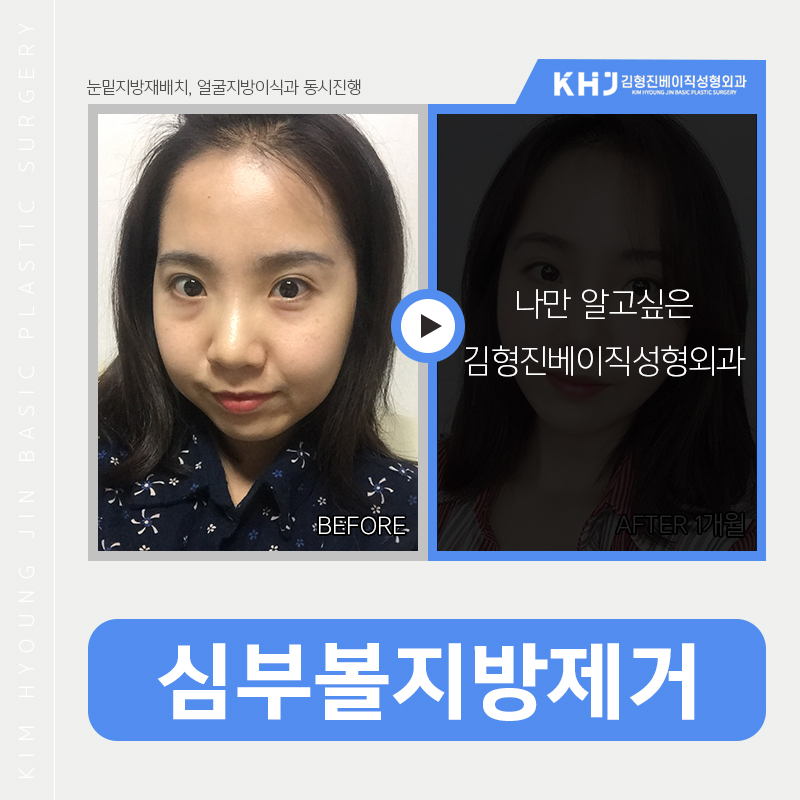 심부볼리프팅으로 해결가능하냐구요? 관련 이미지 3