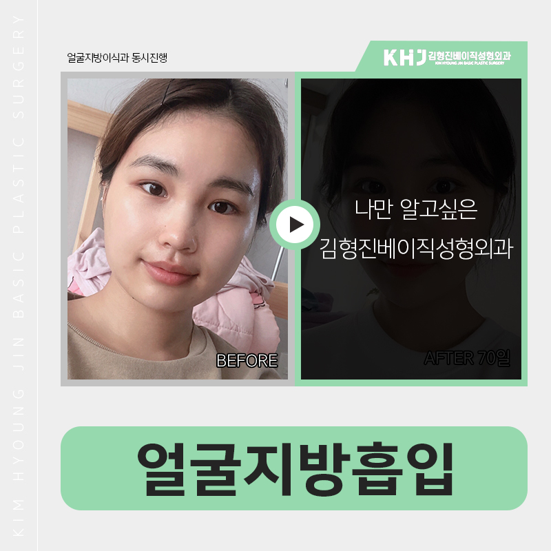 얼굴지방흡입방법 어떻게 진행되냐구요? 관련 이미지 7